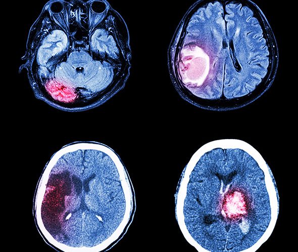 4 tipos de tumores cerebrales