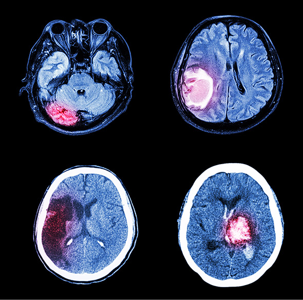 4 tipos de tumores cerebrales